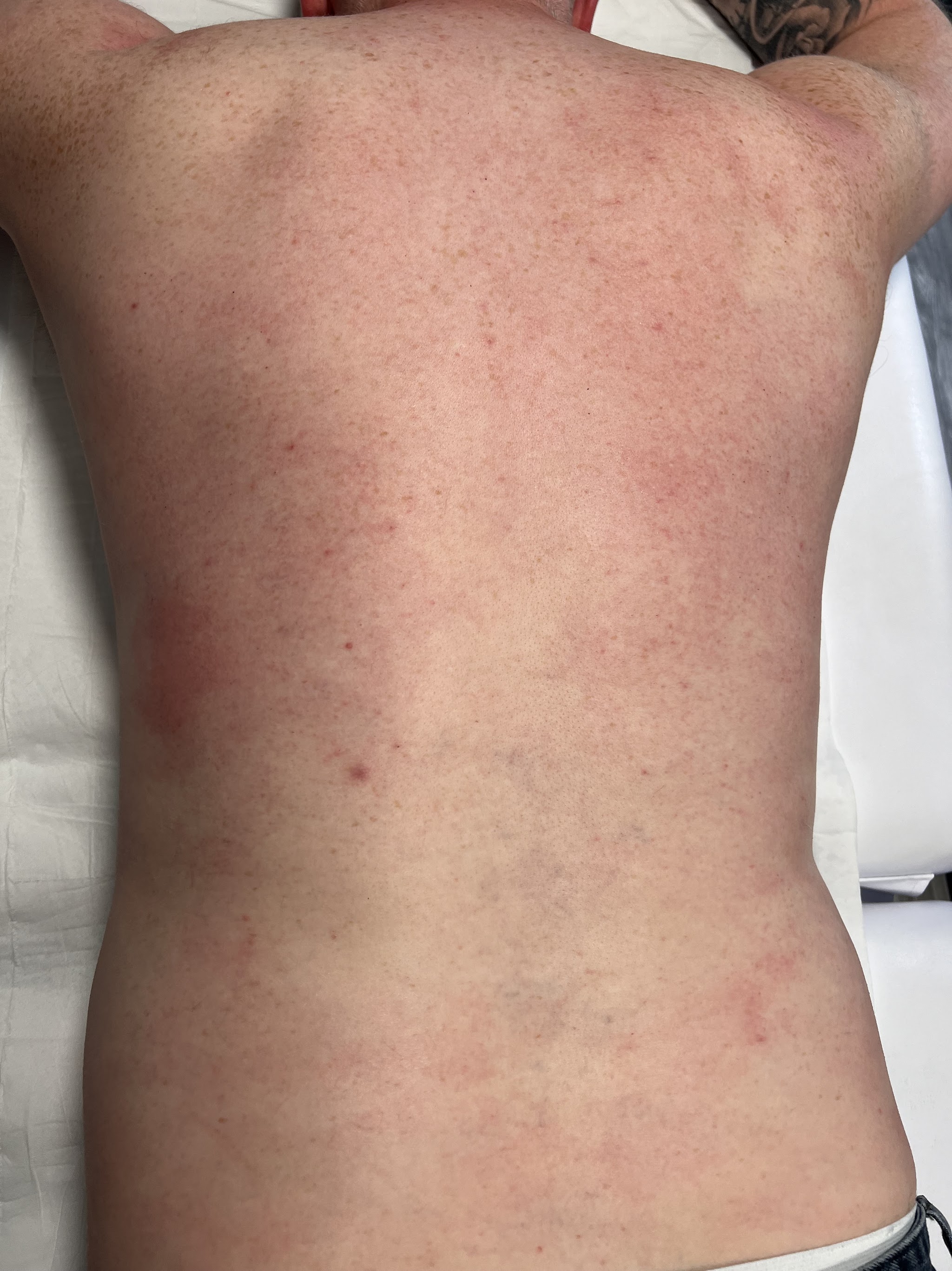 A smooth back after a back wax, lying on the treatment couch