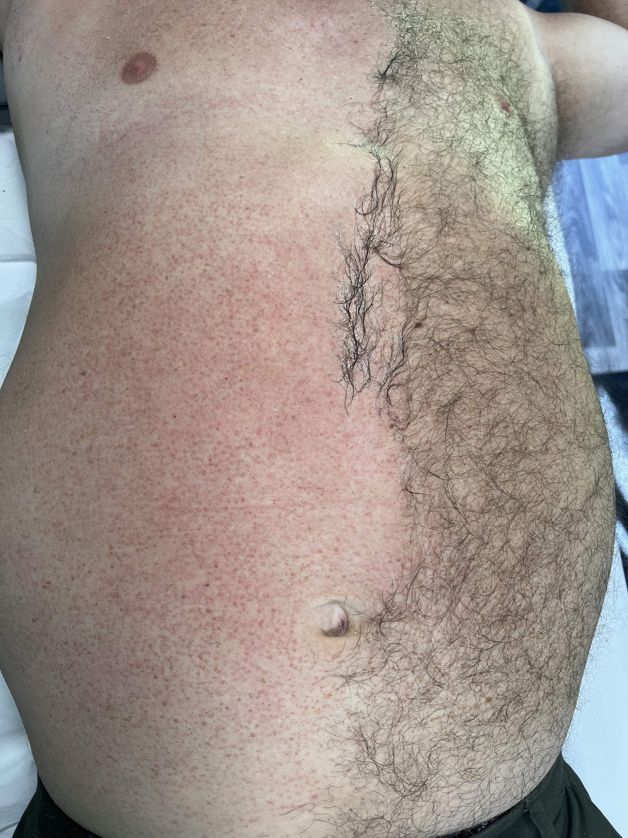 A chest and stomach halfway through waxing, one side smooth and the other still to do