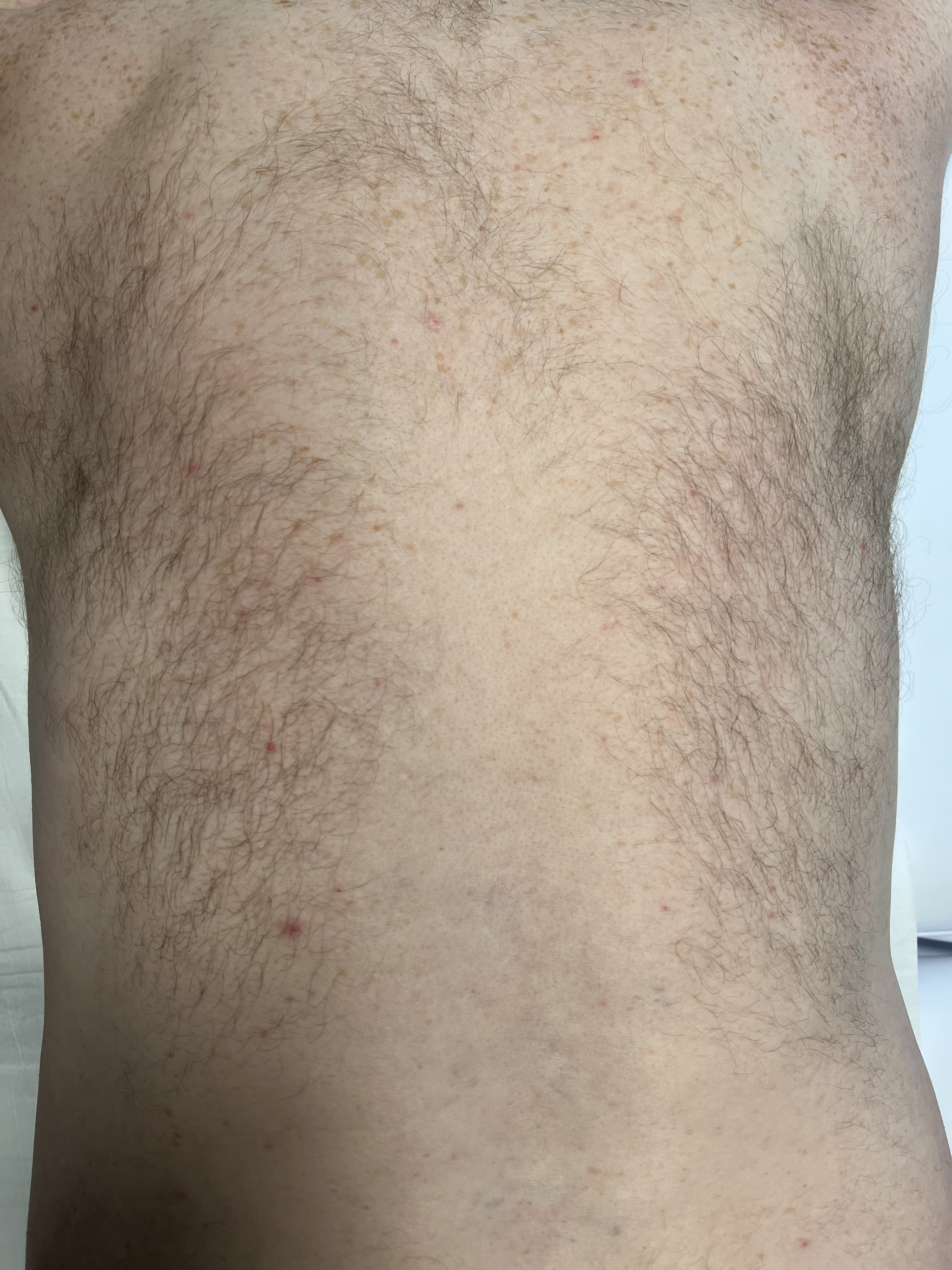 A hairy back before a back wax, lying on the treatment couch