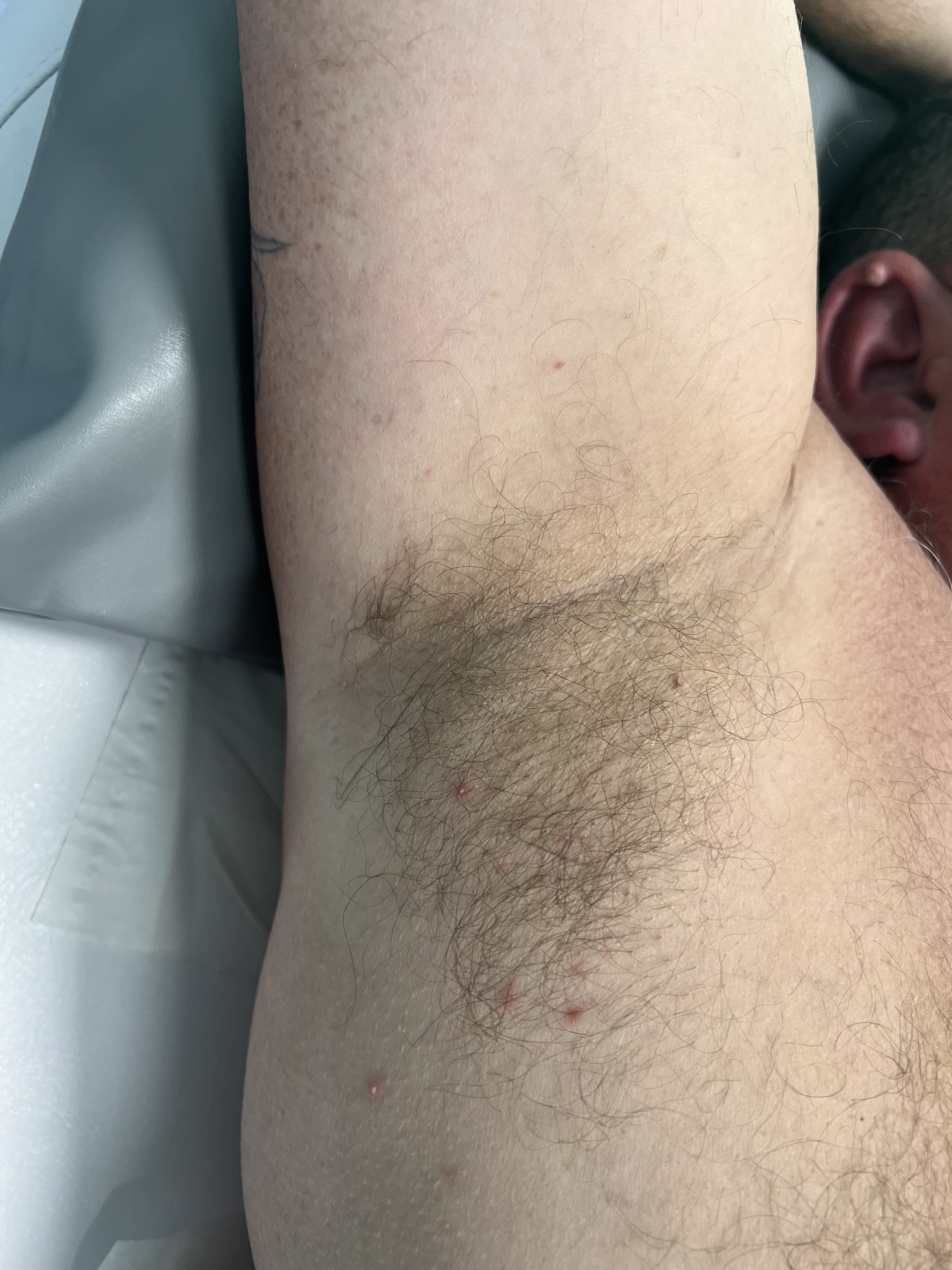 An underarm before waxing